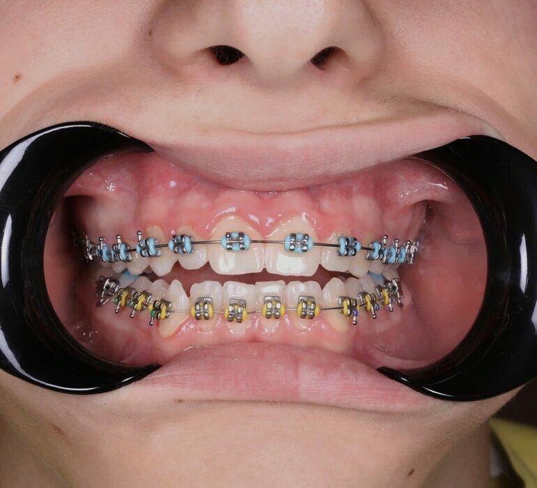 Пропозиція Клініка надає знижку до 20% на всі стоматологічні послуги.